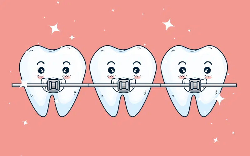 Three teeth bound together with braces