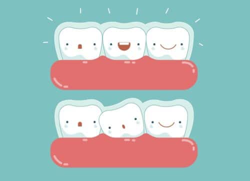 Dental braces invisalign