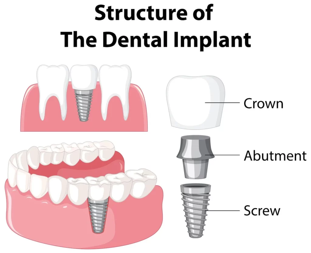 Cuánto vale un implante dental completo 